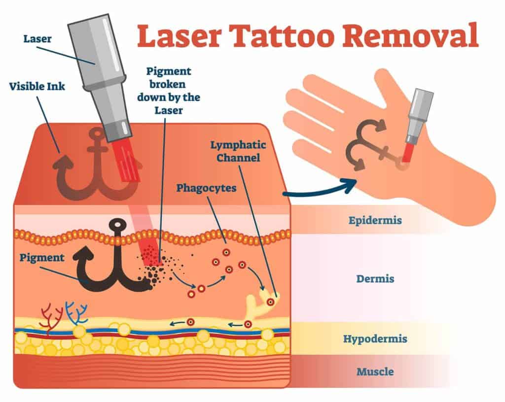 Tattoo removal visual 1024x816 1