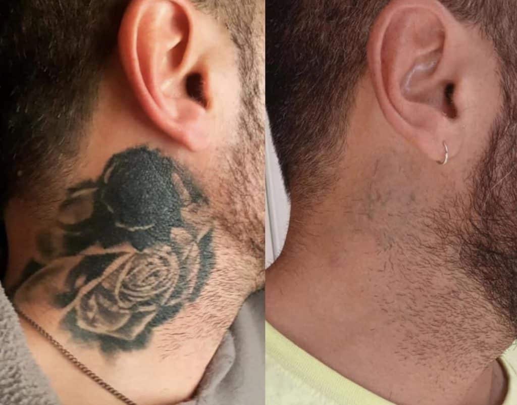 tattoo removal